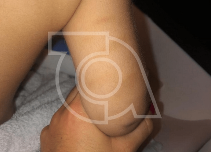 Hematomas en los brazos de uno de los menores que se achacan a los presuntas lesiones (Foto TA)